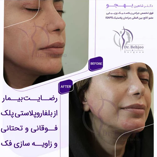 رضایت بیمار از بلفاروپلاستی و زاویه سازی فک