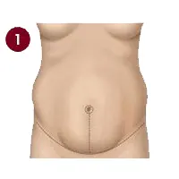 مرحله اول مینی ابدومینوپلاستی