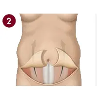 مرحله دوم مینی ابدومینوپلاستی