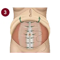 مرحله سوم مینی ابدومینوپلاستی