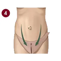 مرحله چهرم مینی ابدومینوپلاستی