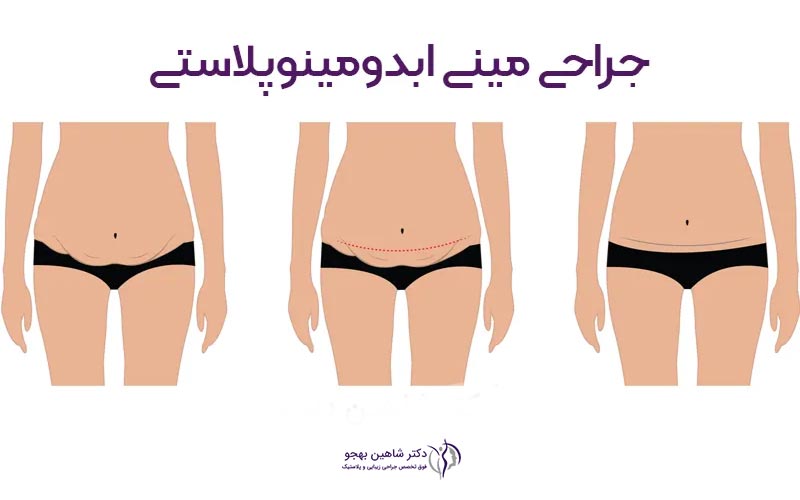 انواع روش های عمل مینی ابدومینوپلاستی و مینی تامی تاک