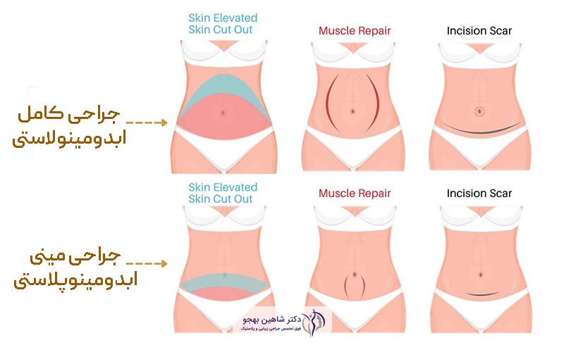 تفاوت مینی ابدومینوپلاستی با ابدومینوپلاستی کامل (جراحی زیبایی شکم)
