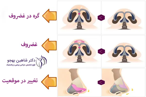 انواع تیپ پلاستی