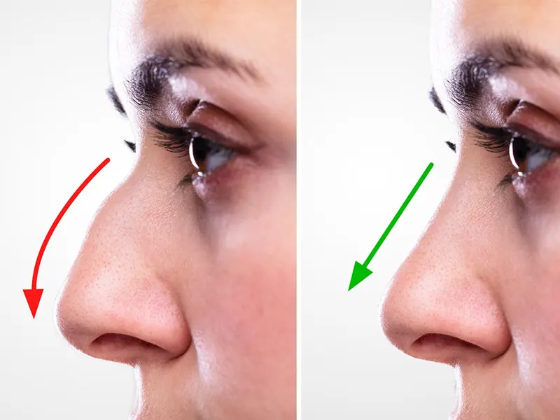 جراحی قوز بینی