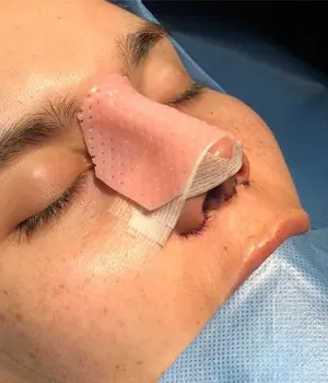 برداشتن گچ بینی