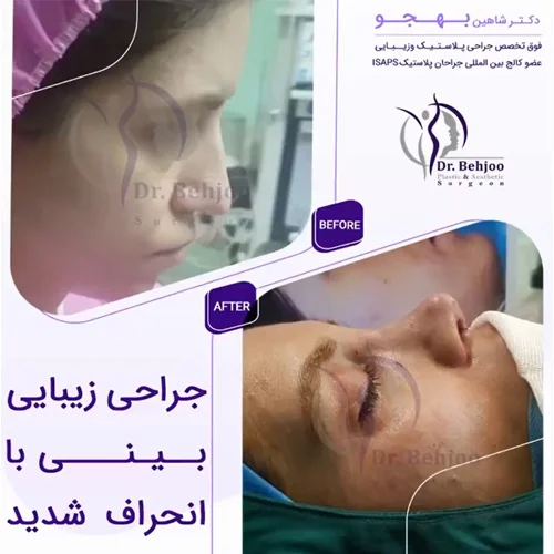 عمل زیبایی بینی