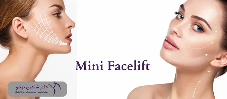 تفاوت مینی لیفت صورت با لیفت کامل