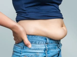 برگشت شکم بعد از ابدومینوپلاستی