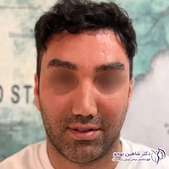 عکس بعد لیفت صورت