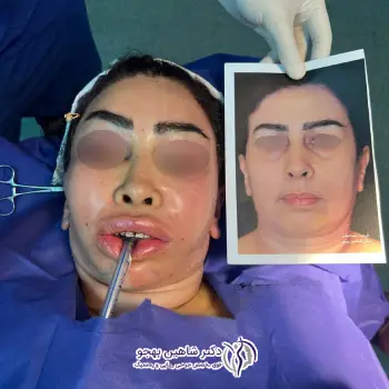 نمونه لیفت آندوسکوپی پیشانی