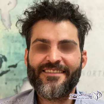 نمونه کار لیفت آندوسکوپی پیشانی