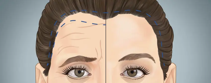 جراحی لیفت ابرو