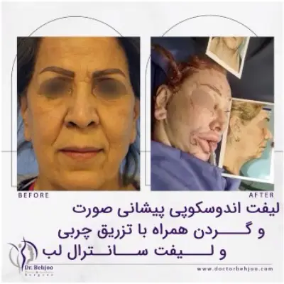 جراحی لیفت صورت