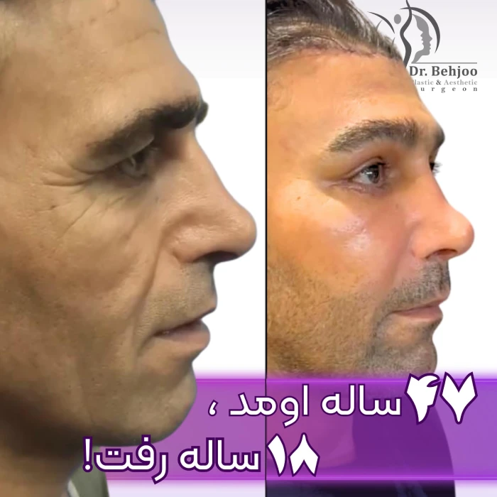 نمونه جراحی لیفت صورت