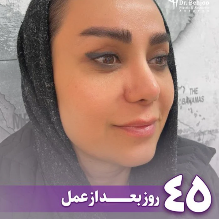 عمل لیفت ابرو