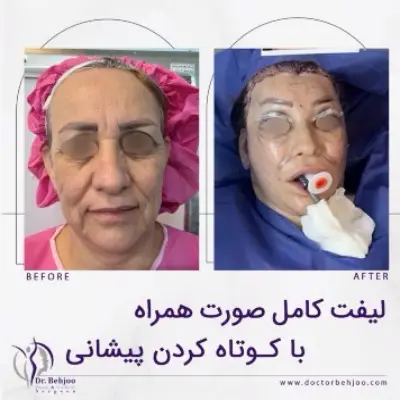 عکس لیفت صورت
