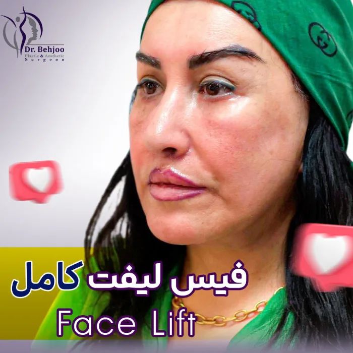 نمونه فیس لیفت صورت