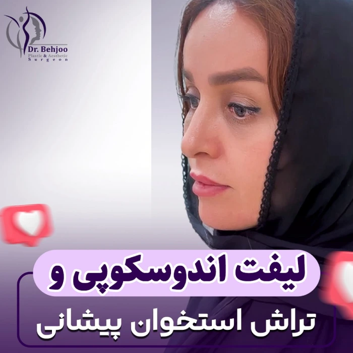 نمونه لیفت آندوسکوپی