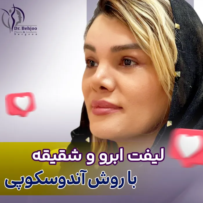 نمونه لیف ت ابرو و شقیقه