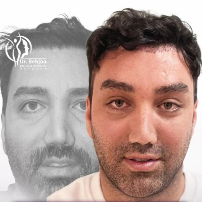 نمونه لیفت ابرو و پیشانی آقایان