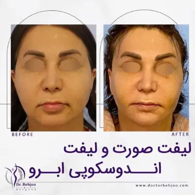 لیفت صورت دکتر بهجو