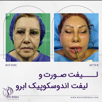 لیفت صورت دکتر شاهین بهجو