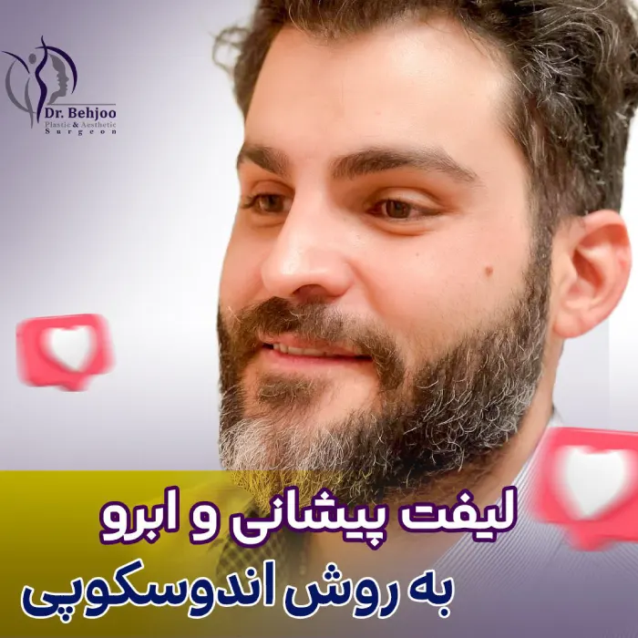 نمونه لیفت ابرو و پیشانی