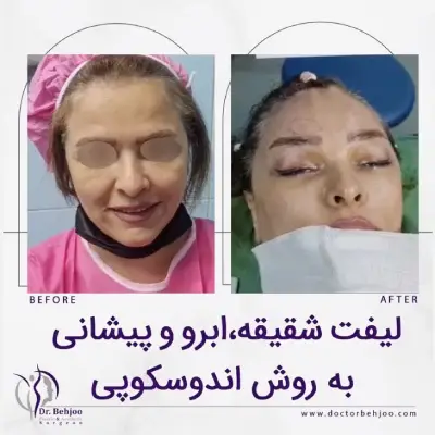 نتیجه لیفت صورت