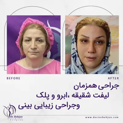 نمونه لیفت صورت بانوان