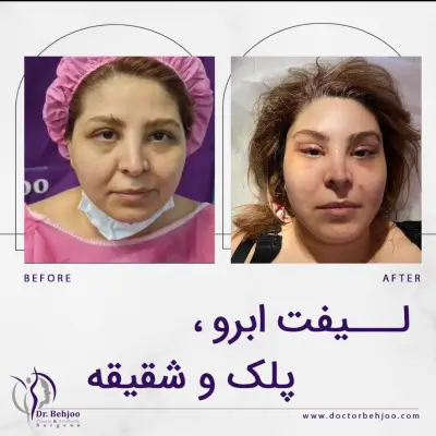 نمونه لیفت صورت بلافاصله بعد عمل