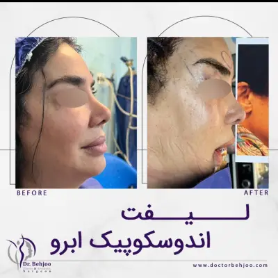 نمونه کار لیفت صورت