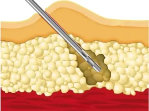 تفاوت ابدو و لیپوماتیک