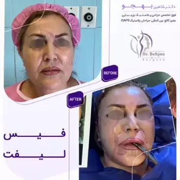 جراحی لیفت پیشانی