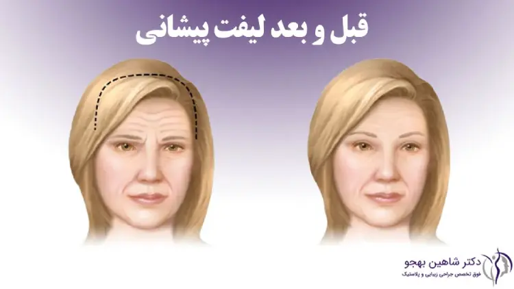 قبل و بعد جراحی لیفت پیشانی