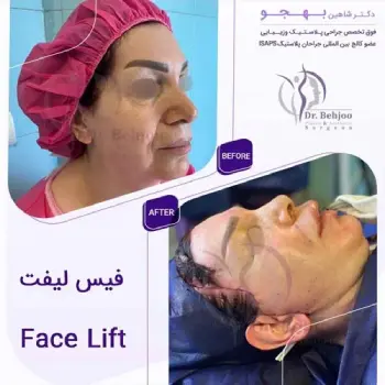 لیفت پیشانی