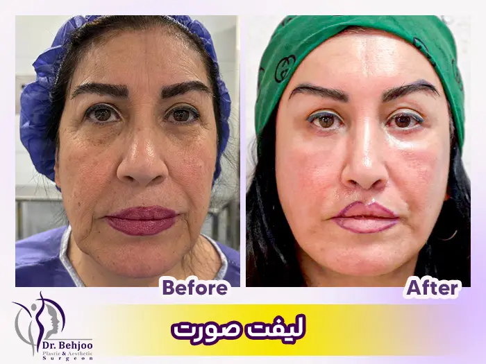 قیمت جراحی لیفت صورت