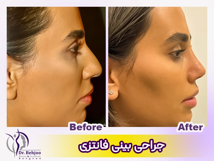 عمل بینی عروسکی