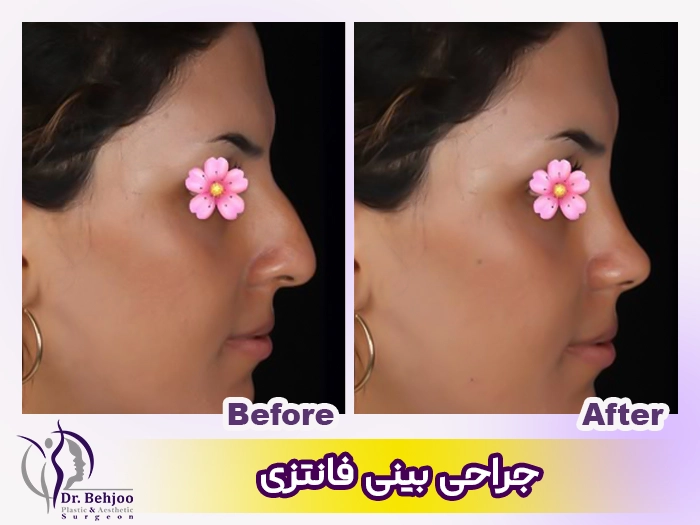 حراحی بینی فانتزی