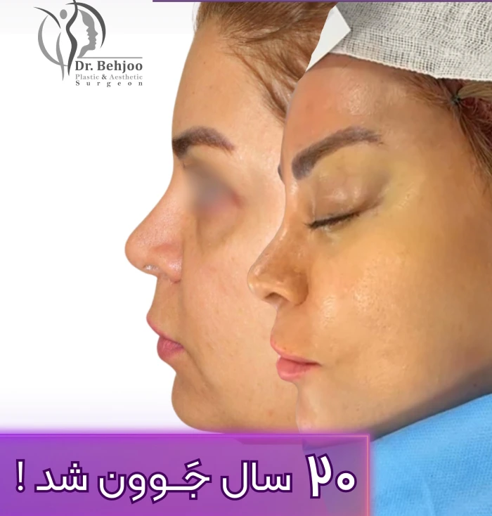 لیفت ابرو و پیشانی