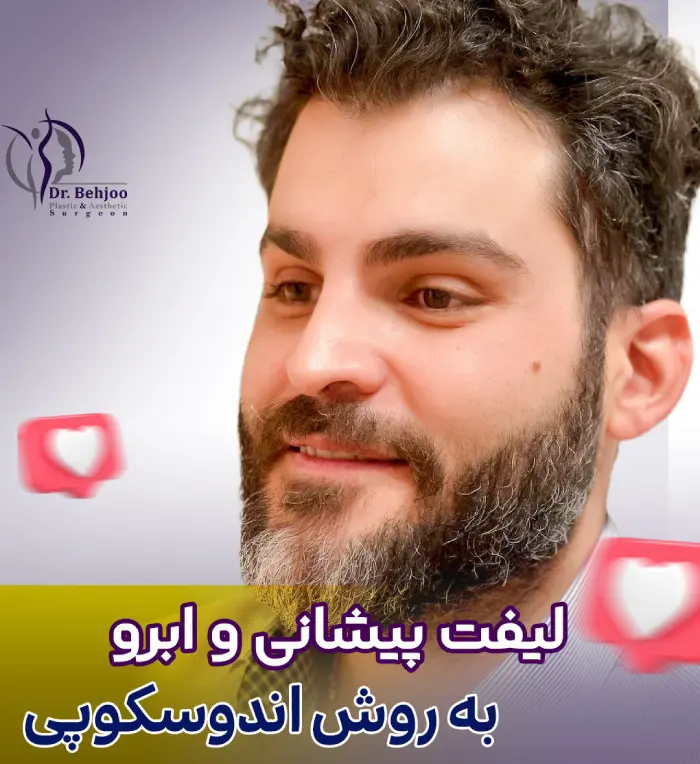 لیفت پیشانی