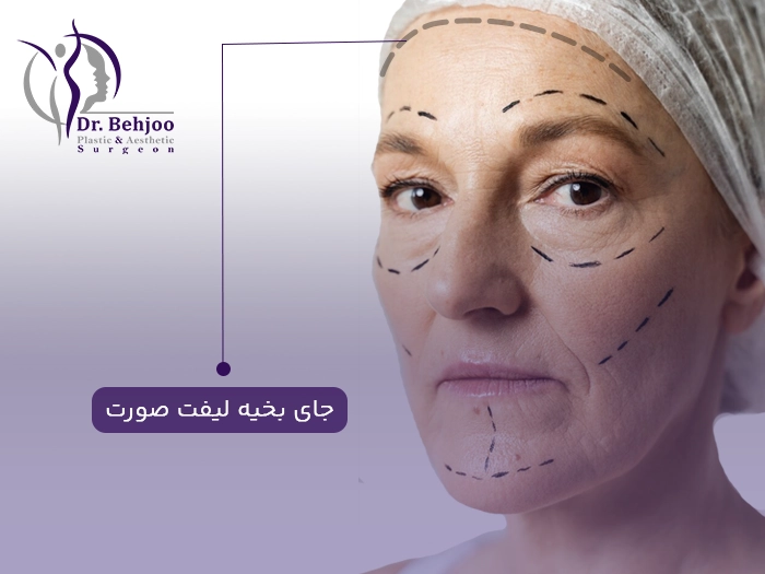 جای بخیه لیفت صورت