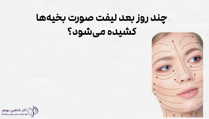 چند روز بعد لیفت صورت بخیهها کشیده میشود؟