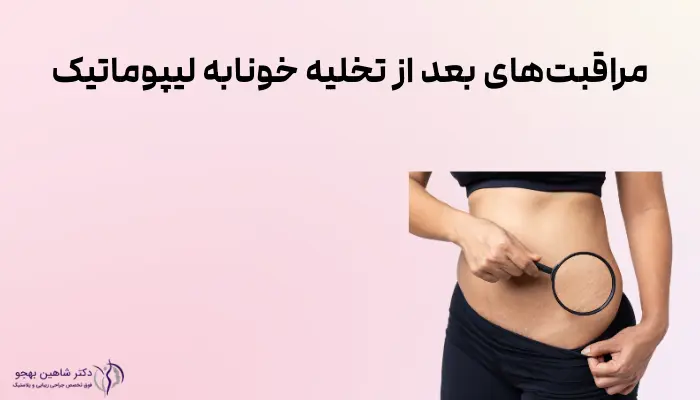 مراقبتهای بعد از تخلیه خونابه لیپوماتیک