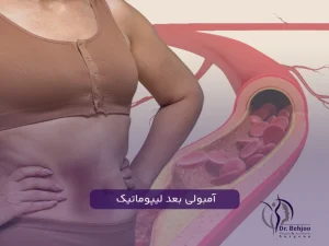 دلیل آمبولی بعد لیپوماتیک