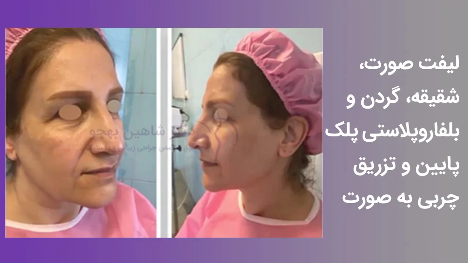 نمونه کار جراحی همزمان با لیفت شقیقه