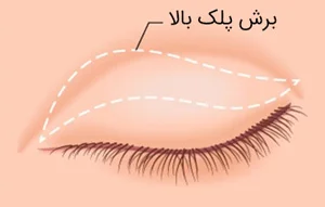 جراحی پلک بالا