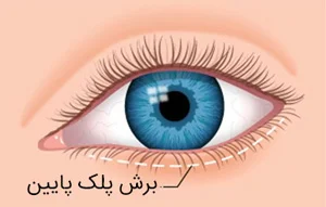 جراحی پلک پایین