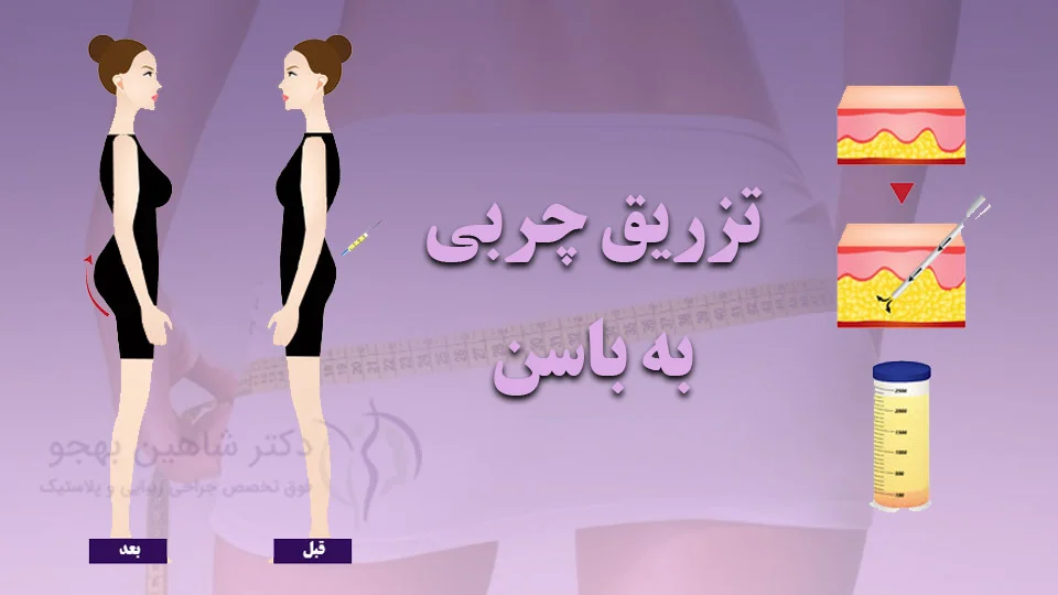 نتیجه تزریق چربی به باسن