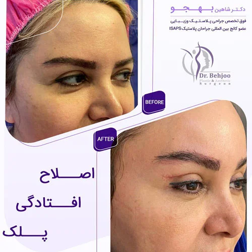 قبل و بعد بلفاروپلاستی